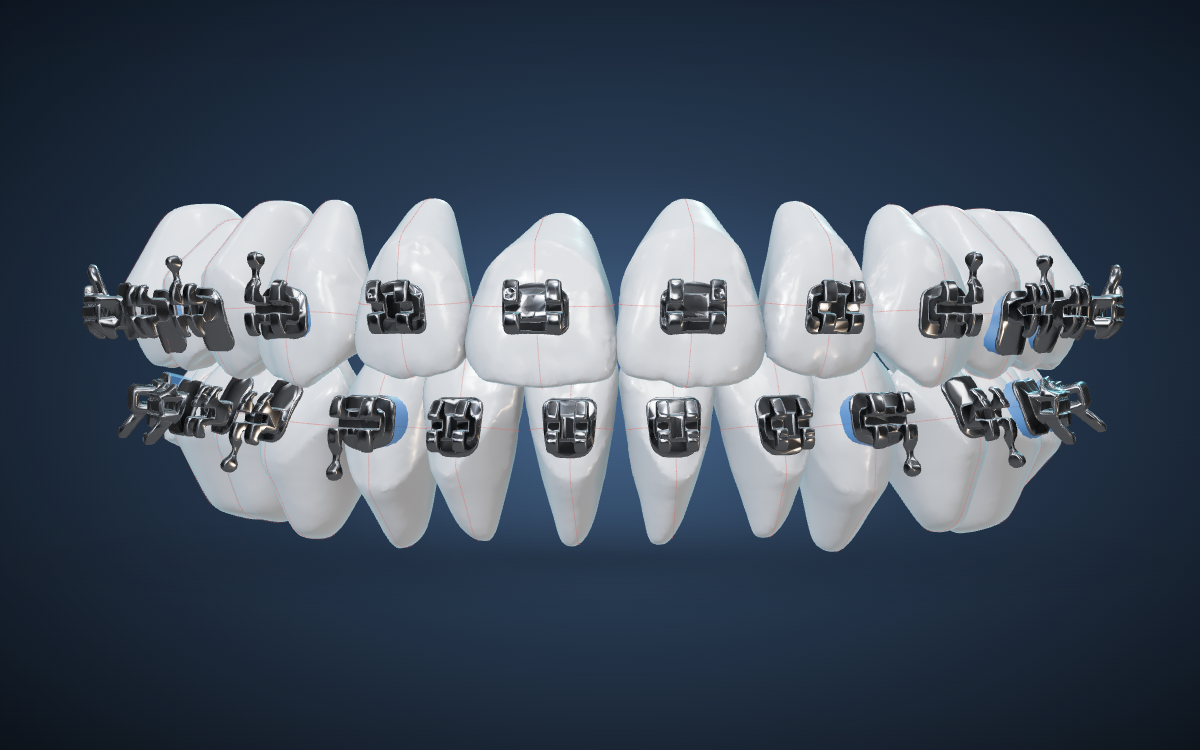 DIBS AI bracket placement software